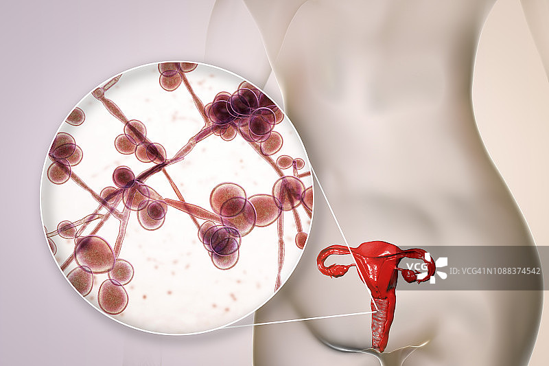 女性白色念珠菌感染插图图片素材