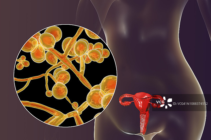 女性白色念珠菌感染插图图片素材