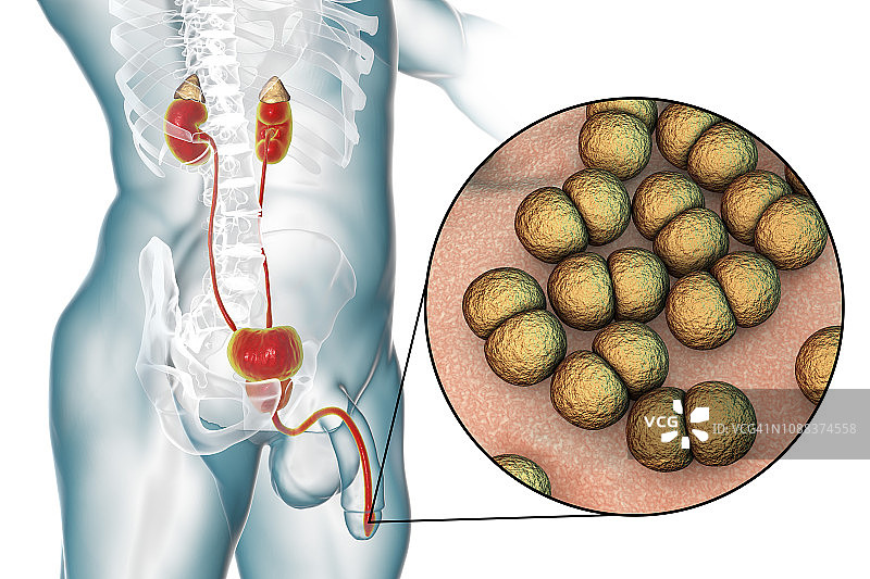 男性淋病感染插图图片素材