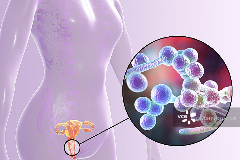 女性白色念珠菌感染插图图片素材