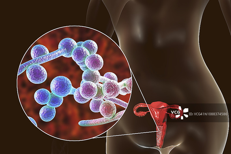 女性白色念珠菌感染插图图片素材