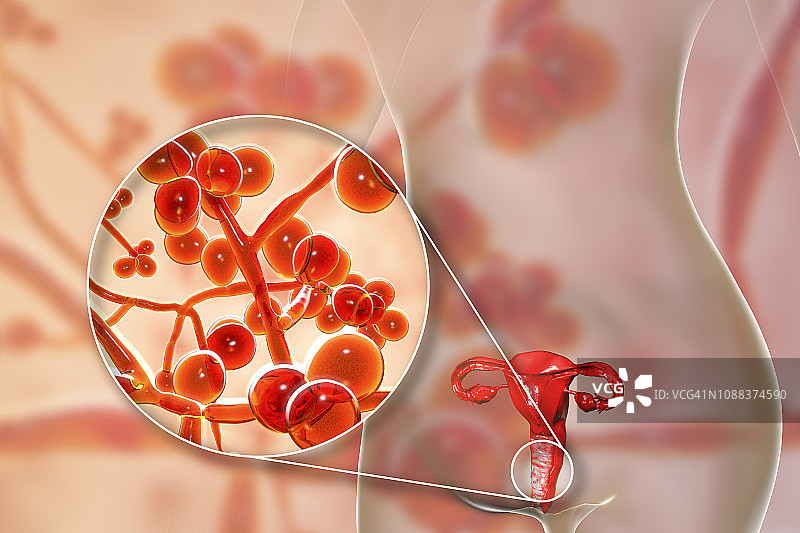 女性耳念珠菌感染插图图片素材