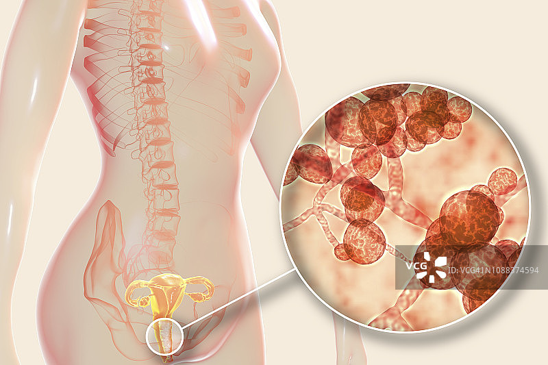 女性耳念珠菌感染插图图片素材