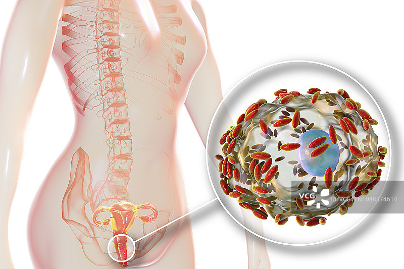 细菌性阴道病，图示图片素材