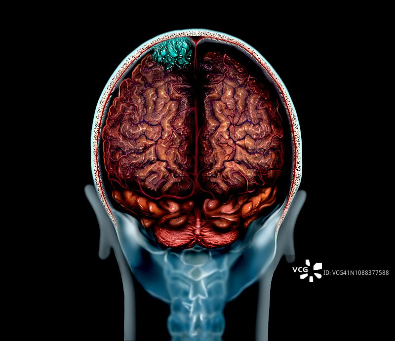脑瘤，核磁共振成像和插图图片素材