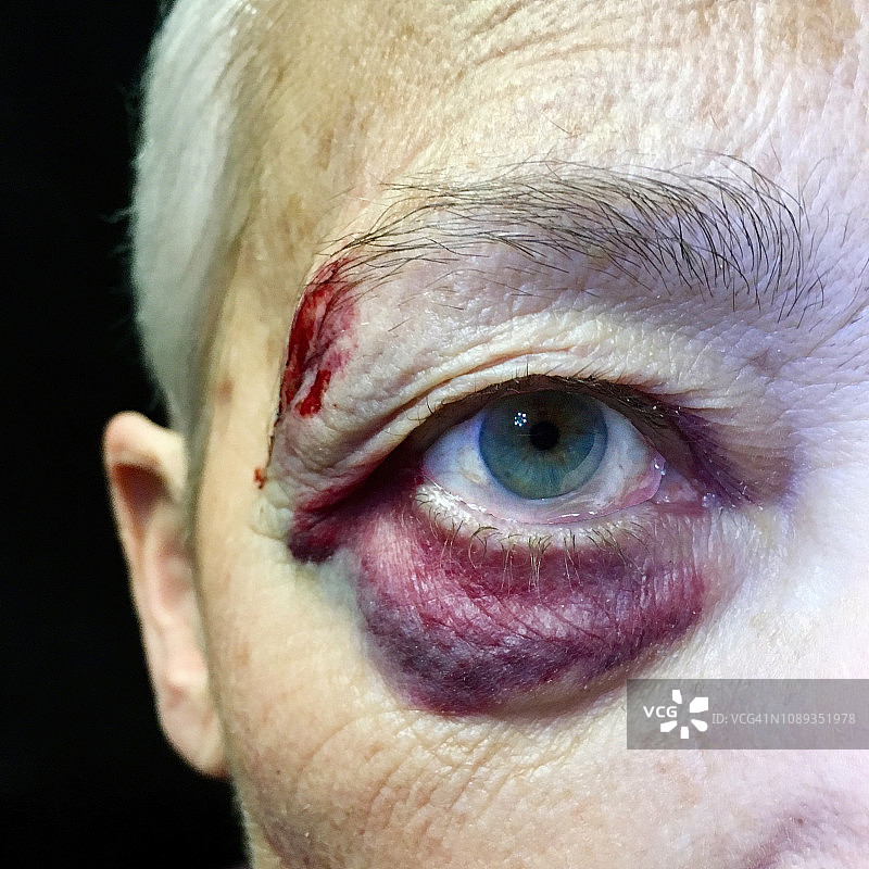 眼部受伤的老年妇女图片素材