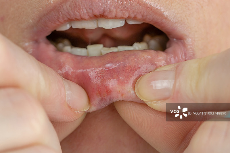 嘴唇上患有口疮的女人图片素材