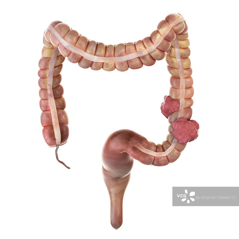 结肠癌插画图片素材