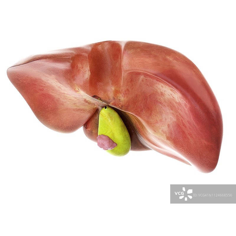 胆囊癌插画图片素材