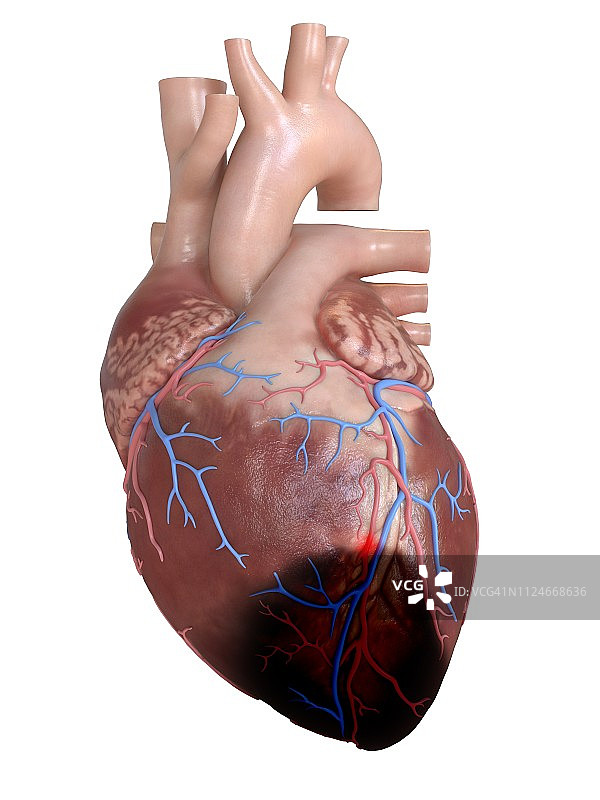 心脏病发作插画图片素材