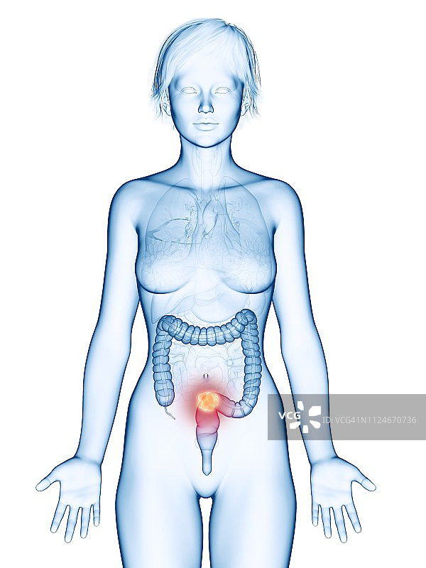 结肠癌插画图片素材