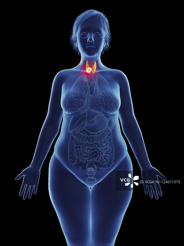 女性甲状腺肿瘤插画图片素材