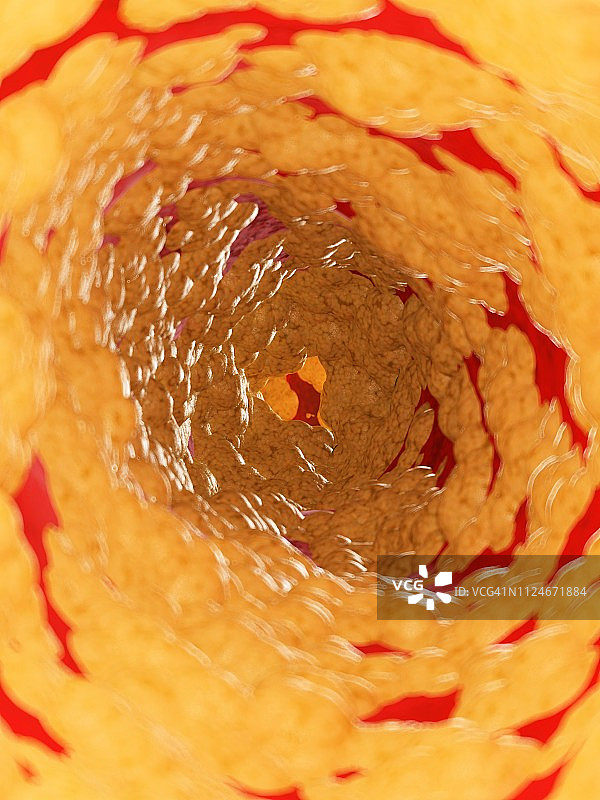 动脉内部脂肪插画图片素材