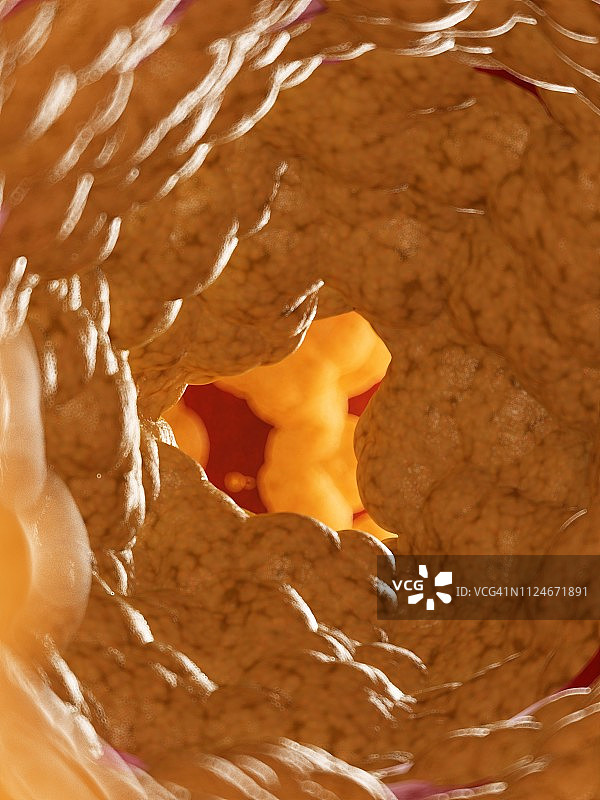 动脉内部脂肪插画图片素材