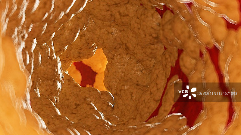 动脉内部脂肪插画图片素材