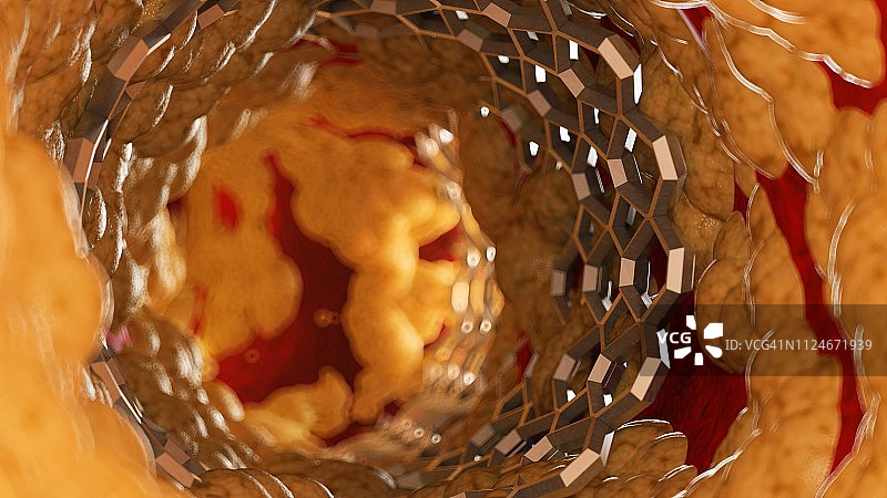 脂肪动脉内支架插画图片素材