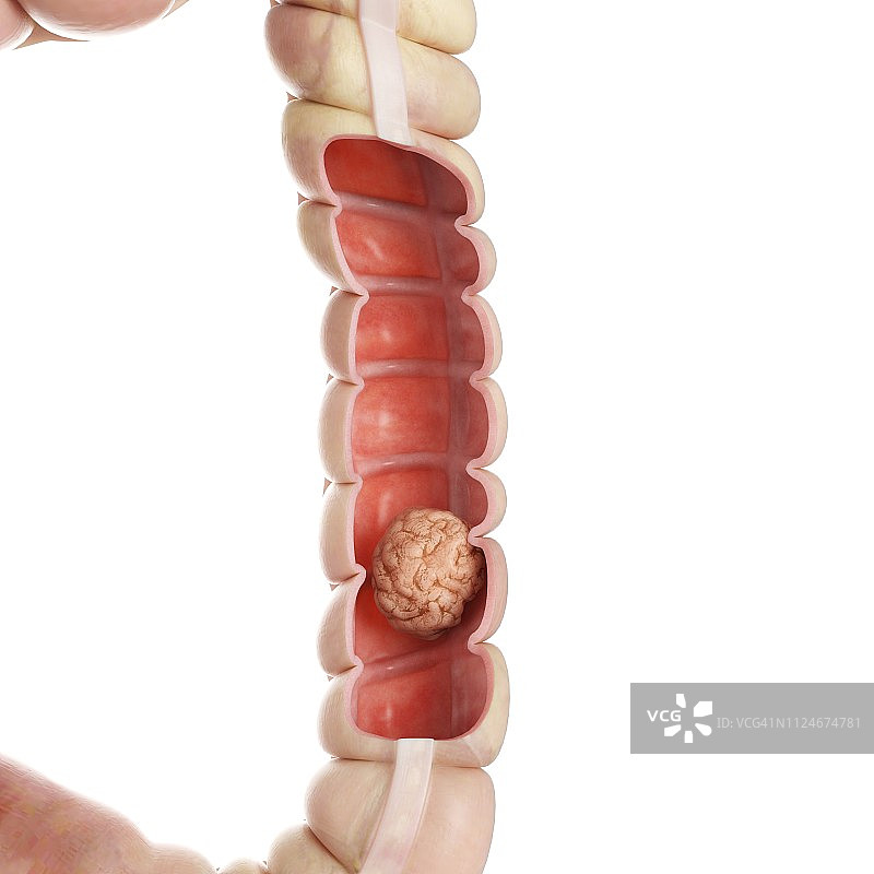 结肠肿瘤插画图片素材