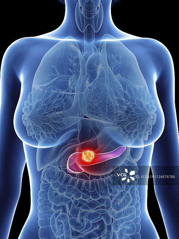 插画：女性的胰腺癌图片素材