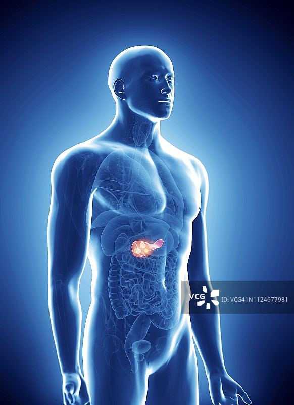 胰腺癌插画图片素材