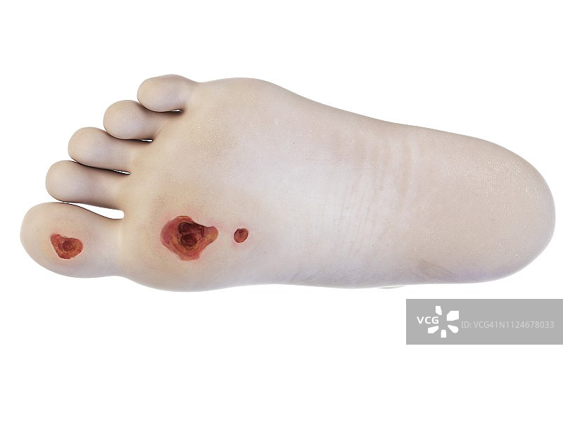 足部溃疡插画图片素材