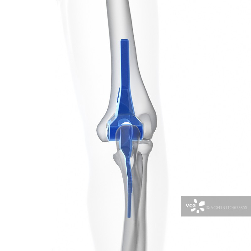 肘关节置换术图示图片素材