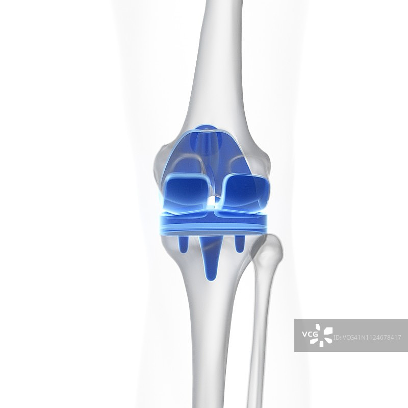 膝关节置换手术图示图片素材