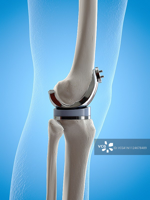 膝关节置换手术图示图片素材