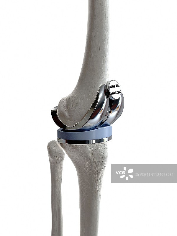 膝关节置换手术图示图片素材