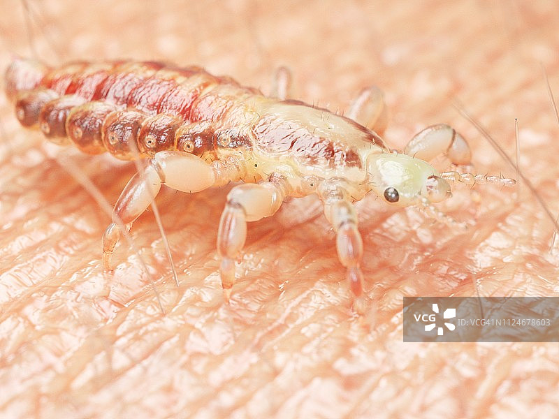 人皮肤上的头虱插画图片素材