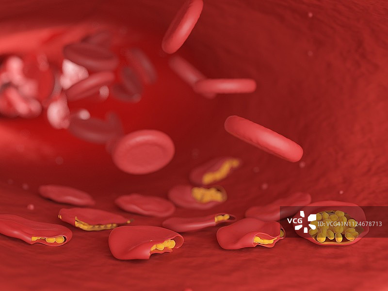 疟疾感染血细胞插画图片素材