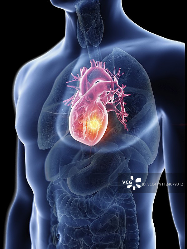 男人心脏肿瘤的插画图片素材