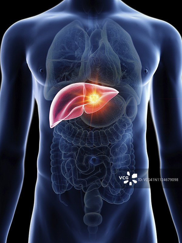 男人肝癌插画图片素材