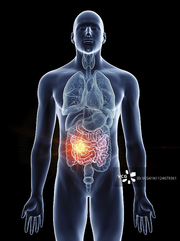 男人小肠癌的插图图片素材