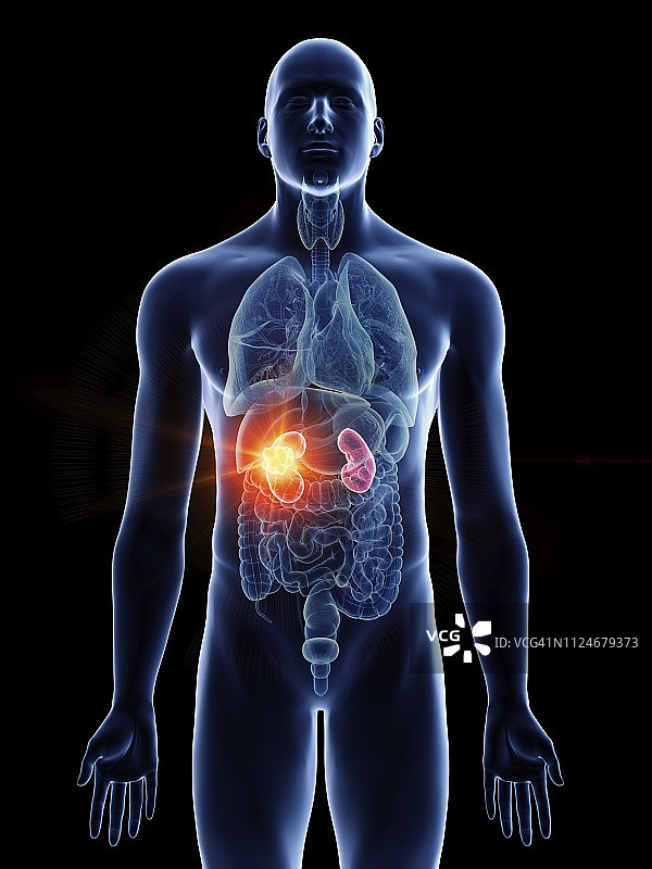 男人肾癌插画图片素材