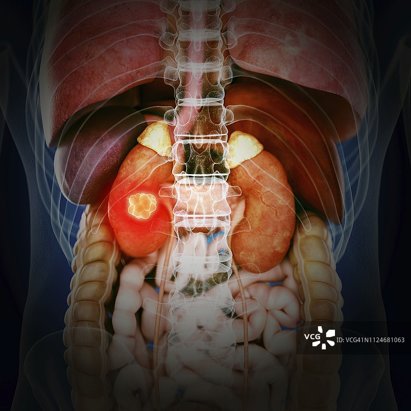 肾癌插画图片素材