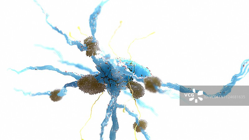 阿尔茨海默病图示图片素材