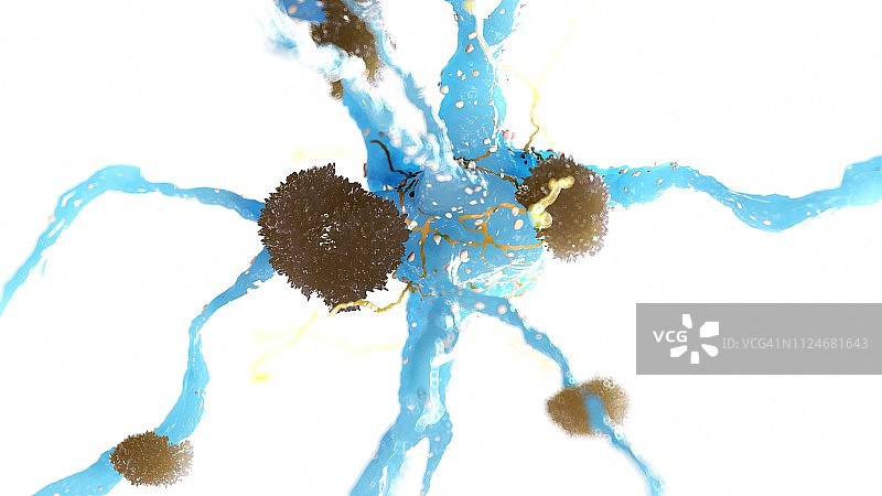 阿尔茨海默病图示图片素材