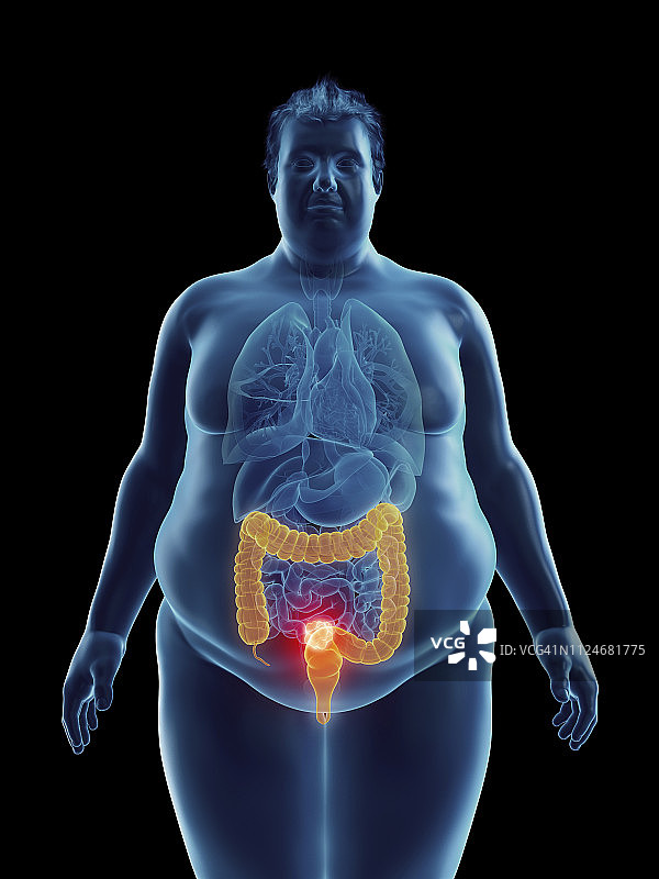 肥胖男子结肠肿瘤插图图片素材