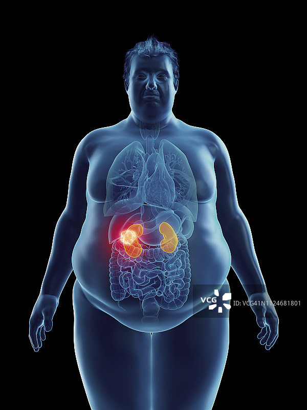 肥胖男人肾肿瘤插画图片素材