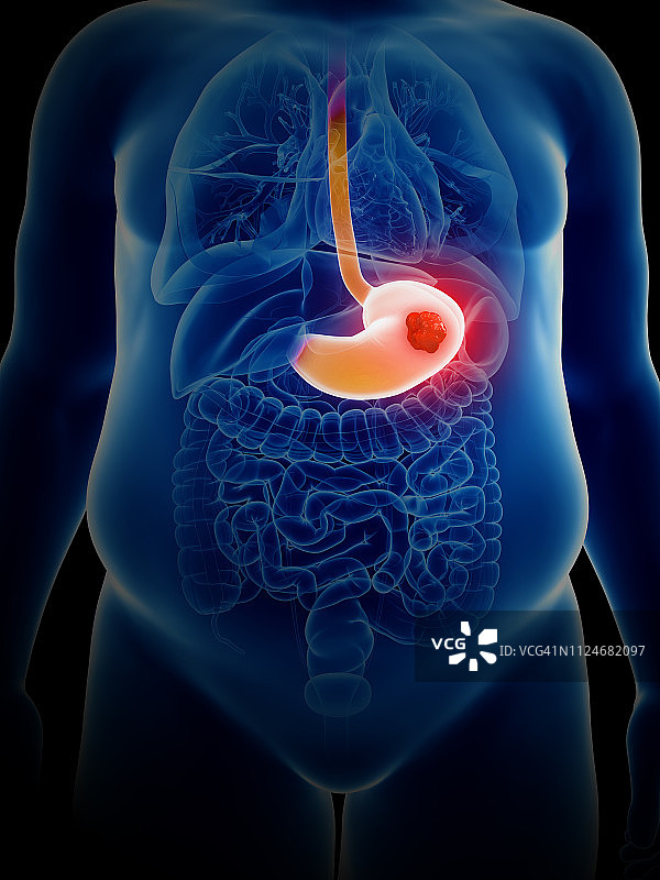 胃癌插画图片素材