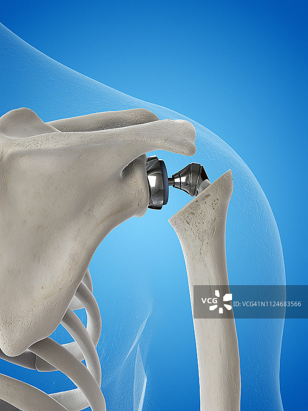 肩关节置换插画图片素材