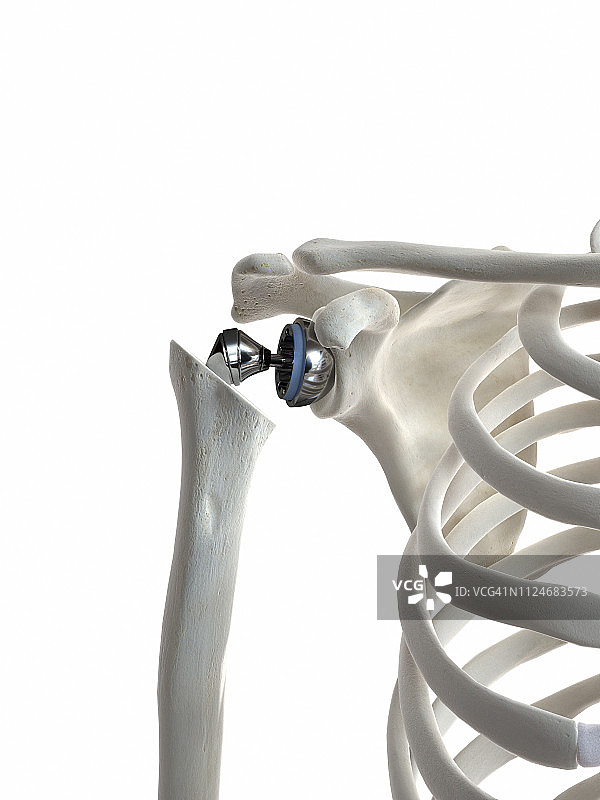 肩关节置换插画图片素材