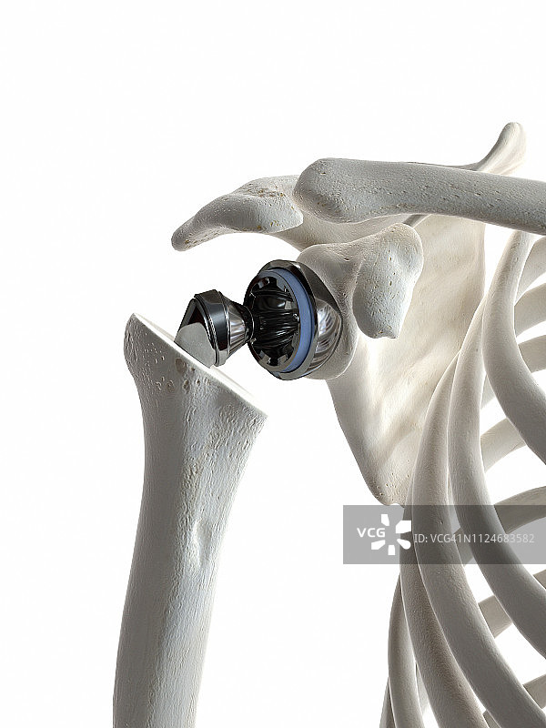 肩关节置换插画图片素材