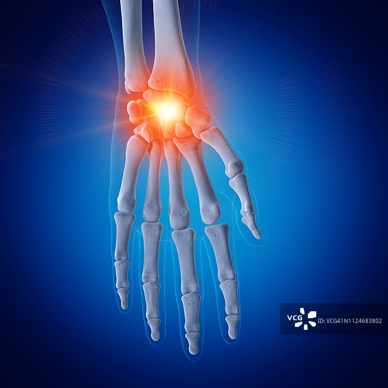 手腕疼痛插画图片素材