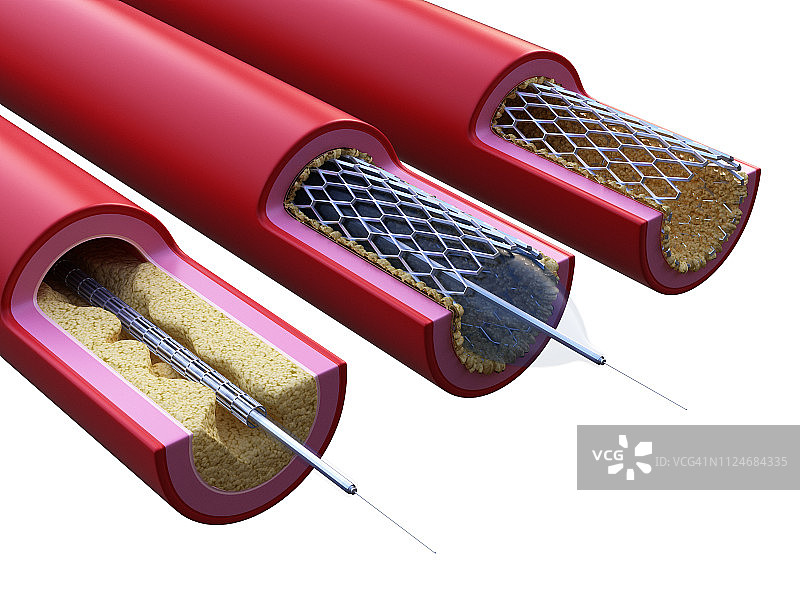 支架植入过程插画图片素材