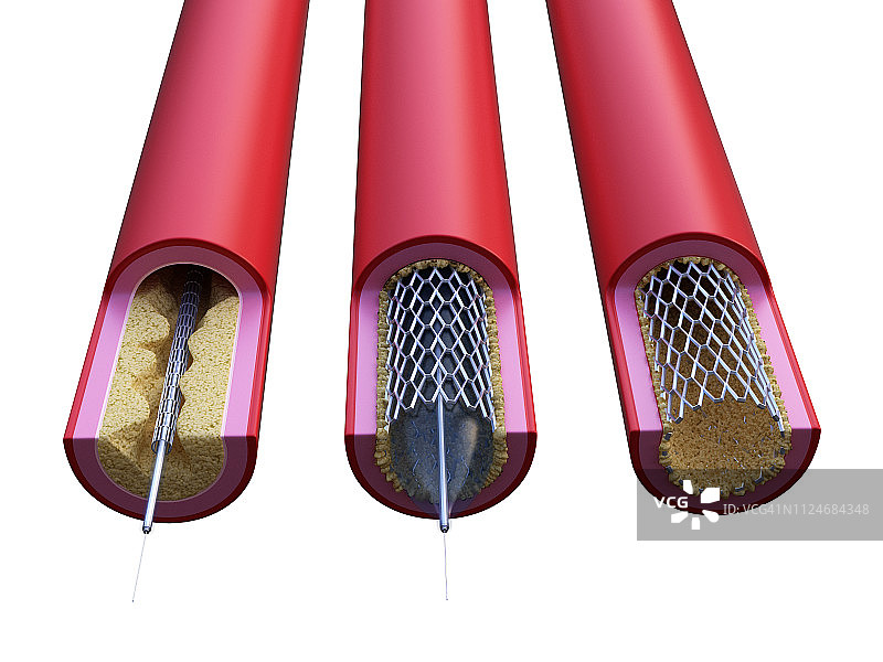 支架植入过程插画图片素材
