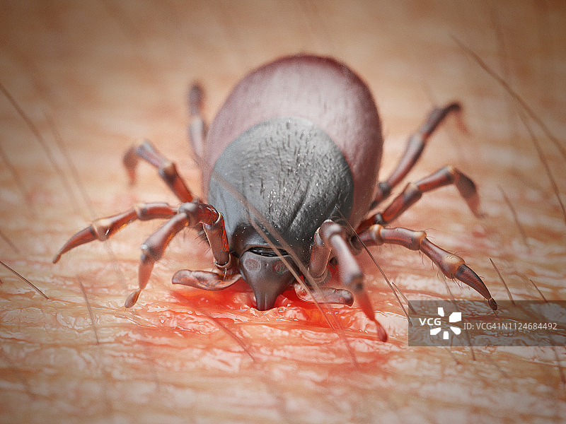 蜱虫叮咬人皮肤的插画图片素材