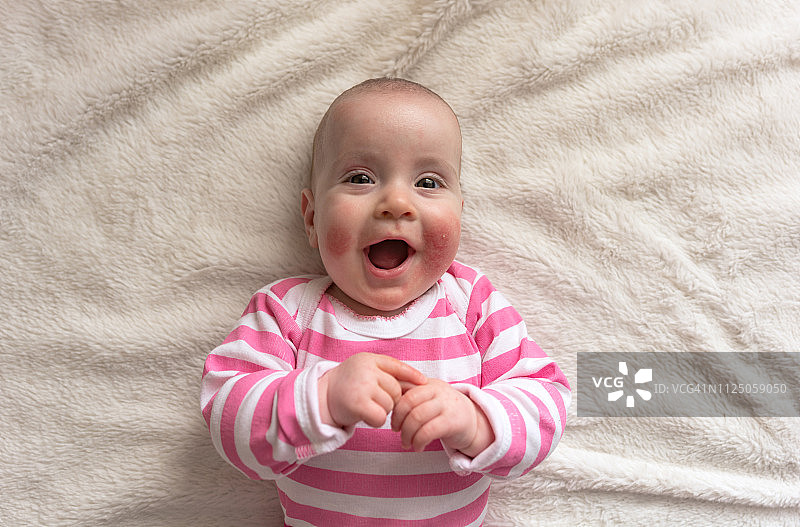 婴儿皮疹概念图片素材