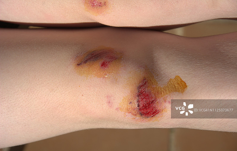 跌倒后的膝盖受伤图片素材