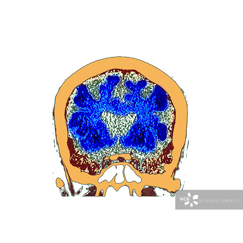 痴呆症大脑CT扫描图片素材